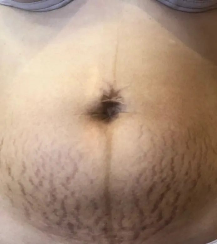 Antes